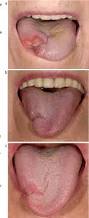 Image result for Jaw Claudication