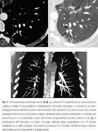 Visualizzazione diretta dell'embolo come area di minor riempimento all'interno del vaso, in parte o completamente. La Dignostica Per Immagini Nella Pratica Clinica Tc Multidetettore