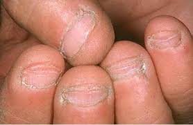 Check spelling or type a new query. Bee Polished Rehab Your Nails What Is A Long Nail Bed