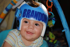 Torticollis: The Baby in the Little Blue Helmet