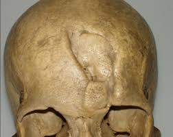 Fatal damage to the brain may occur without any fracture of the skull. Types Of Peri Mortem Trauma