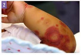 An Infant S Sudden Onset Rash And Swelling Can You Identify The Cause Consultant360