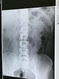 My X Ray After Kidney Stone Surgery Kidney Stones Kidney Stone