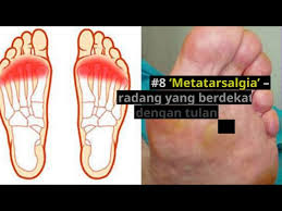 Namun, tidak sedikit manusia yang mempunyai satu. Sakit Tapak Kaki Penyebab Rawatan Dan Cara Menghilangkan Rasa Sakit