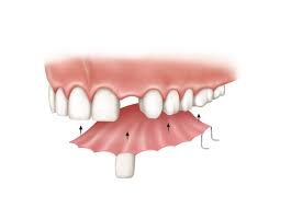 Implants Vs Dentures Bridges Implants Vs Dentures Bridges American Academy Of Implant Dentistry