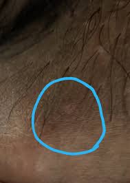 Due to being hairy and prone to. Is This Herpes On My Scrotum Depressed Genital Herpes Simplex Forums Patient