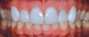 What Color Should Your Veneers Be Larry Saylor D M D