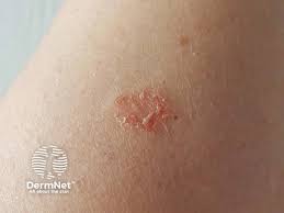 Image result for Eczema nummulare