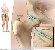 Illustration Showing Hip Labral Tear I Was Told That You Susan And His Ex Constantly Was Advising To Physica Hip Surgery Recovery Hip Injuries Torn Labrum Hip
