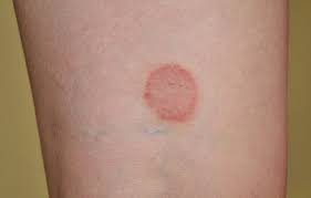 Umumnya gatal dan bentol dapat hilang dengan sendirinya, tetapi pada beberapa kasus rasa gatal akan semakin parah apabila tidak segera ditangani penyebabnya. Lichen Planus Gejala Penyebab Dan Mengobati Alodokter