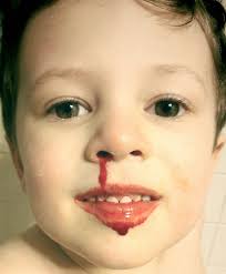 We did not find results for: Nosebleed Wikipedia
