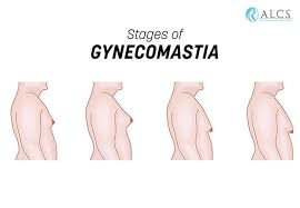 Image result for Gynecomastia