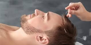 It is said that regular acupuncture sessions can help in stimulating hair growth and restore the balance in the body. Can Acupuncture Really Affect Hair Growth Ahs India