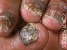Image result for onychomycosis
