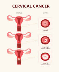 Image result for Cervical Cancer