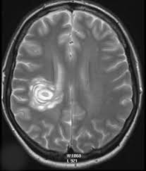 Erste fälle wurden in den usa diagnostiziert. Autoimmun Und Mehr Aus Neuroradiologischer Perspektive G Schuierer Zentrum Neuroradiologie Regensburg Pdf Kostenfreier Download