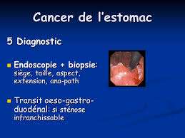 Le cancer de l'estomac est une forme de cancer qui se développe à partir des cellules de la muqueuse de l'estomac. Cancer De L Estomac 1 Epidemiologie Ppt Video Online Telecharger