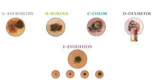 Basal cell carcinoma, squamous cell carcinoma and melanoma. Melanoma Symptoms And Detection