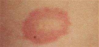 Image result for Papular urticaria