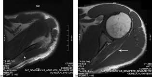 Parsonage Turner Syndrome Sciencedirect