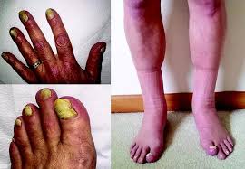 Image result for Yellow nail syndrome feet
