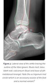 Image result for Ankle XRay