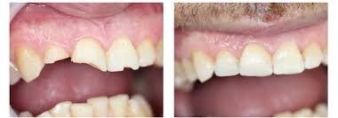 But one thing that he does not do best is when it comes to his teeth. How To Fix A Chipped Cracked Or Broken Tooth Including Costs Prices