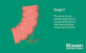 If you have any sign of bleeding from your bottom they can also use the sigmoidoscope to carry out a biopsy. What Is Bowel Cancer Bowel Cancer Explained Bowen Icon Cancer Centre