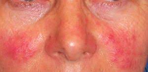 El tratamiento más potentente para eliminar al coronvirus precozmente, les presento mi protocolo base : Nuevo Tratamiento Para La Rosacea Ivermectina En Crema Doctora Lorea Bagazgoitia Dermatologia