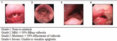 proposed lingual tonsil grading scale download scientific