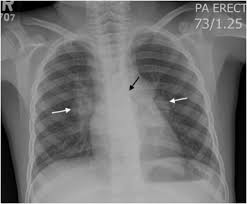 Therefore, all persons with chest radiographic findings suggestive of tb. Reliability Of Chest Radiograph Interpretation For Pulmonary Tuberculosis In The Screening Of Childhood Tb Contacts And Migrant Children In The Uk Clinical Radiology