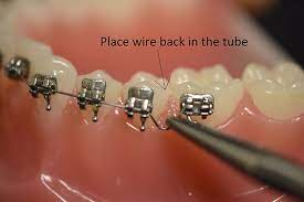 Kaise katen ghar par braces ki taar? Ortho Care From Home Sayre Orthodontics Bozeman Mt