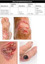 This tightening may cut off the circulation. Racgp Burns Dressings