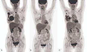 Breast Cancer Metastases Bone Practiceupdate
