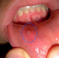 Inside toddler mouth sores pictures. Mouth Ulcer Wikipedia