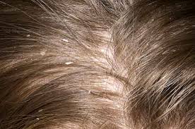 Image result for white scabs on the head in children