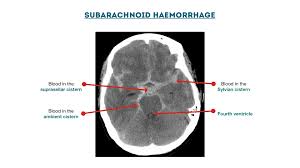 Ct Head Interpretation Radiology Geeky Medics