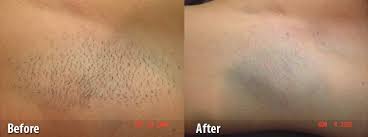 However, the length of time side effects last can depend on the practitioner performing the procedure, and the measures you take to both prepare for sessions, and care for your skin afterwards. Laser Hair Removal Reduction Treatments Lock Haven Williamsport