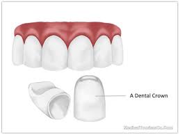 Hey,i can only talk about the cost of a dental crown in india. Dental Crowns In Costa Rica Best Cost Of Dental Caps In San Jose