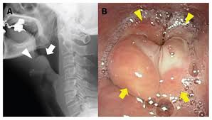 Image result for Epiglottitis