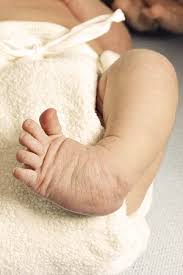 Image result for Clubfoot