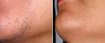 5511 capital center dr, ste 102. Ipl Laser Therapy Laser Hair Removal In Raleigh Nuderma Health