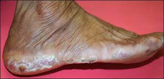 Image result for Onychotillomania feet