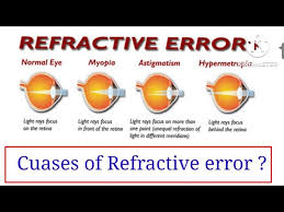 Image result for Refractive Error