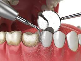 According to the american dental association, the average costs of routine procedures are as follows: Low Cost Teeth Cleaning In Houston Tx Affordable And High Quality Deep Cleaning