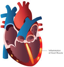 Image result for Myocarditis