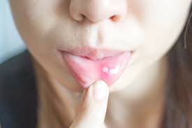 Panas dalam adalah penyakit yang menyerang area mulut terutama di bibir. Obat Panas Dalam Alami Dan Obat Medis Yang Bisa Anda Coba