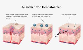 Feigwarzen Bilder Wie Es Aussieht Doktorabc