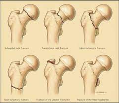 Femur Neck Fractures Classification Orthopedics Orthopedic Nursing Medical Coding