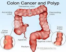 Image result for Colorectal Cancer